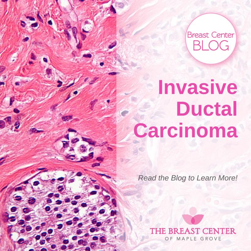 What Is Invasive Breast Carcinoma Grade 2